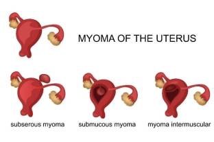 tipos-fibromas-uterinos-1.jpg